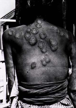 leprosy