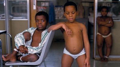rickets, a nutritional disease