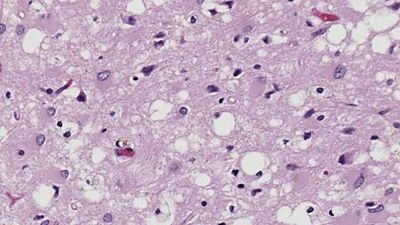 Creutzfeldt-Jakob disease