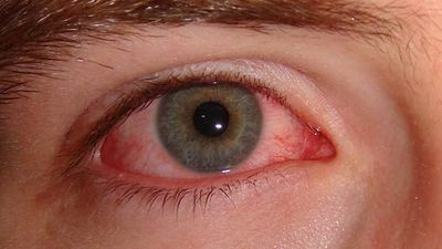 conjunctivitis