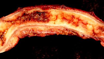 appendicitis